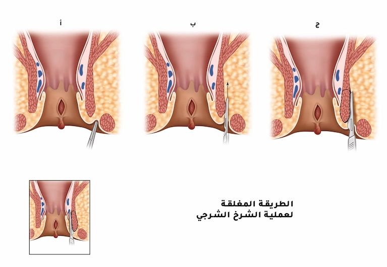 الطريقة المغلقة لعملية الشرخ الشرجي
