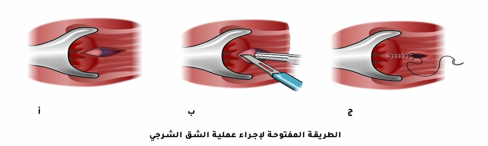 الطريقة المفتوحة لعملية الشرخ الشرجي